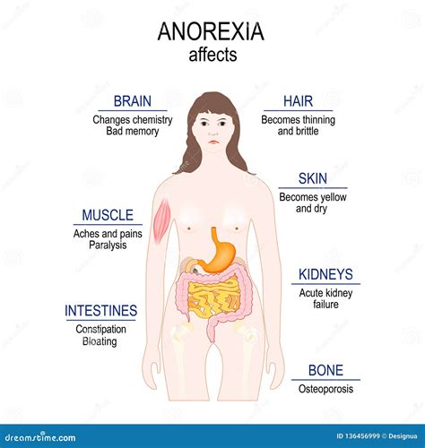 Anorexia Nervosa is an Eating Disorder. Low Weight Stock Vector