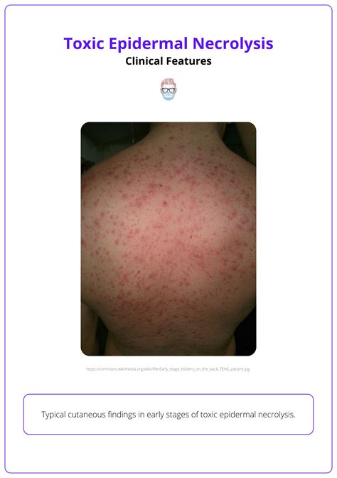 Toxic Epidermal Necrolysis (TEN): Risk Factors, Clinical Features