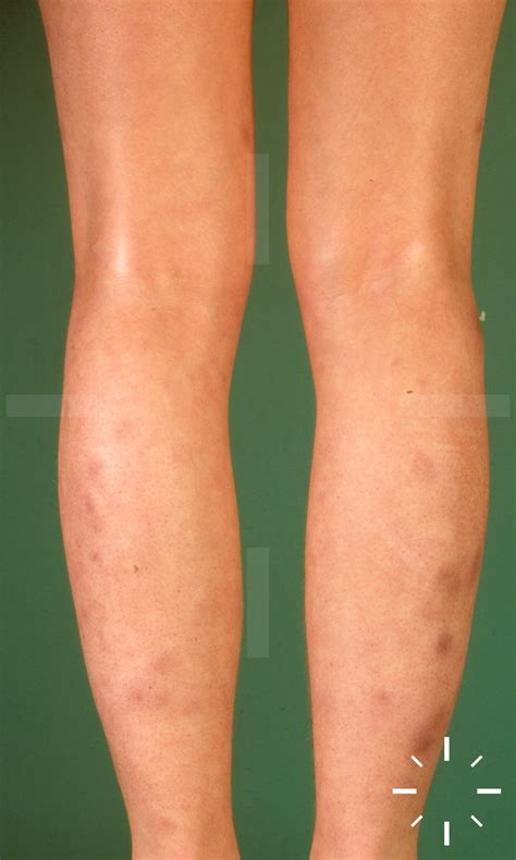 DermaCompass - Erythema nodosum