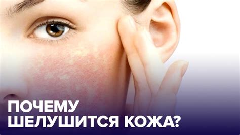 Почему КОЖА ШЕЛУШИТСЯ и как ее спасти? - YouTube