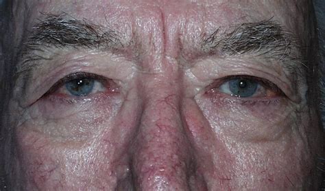 Entropion, post-op - American Academy of Ophthalmology
