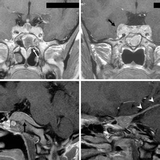 Preoperative CT scan: mucosal thickening in the sphenoethmoidal recess... | Download Scientific ...