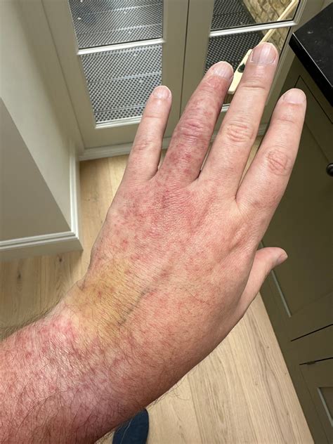 Vietnamese Giant Centipede Bite