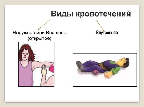 Первая помощь при кровотечениях - презентация онлайн
