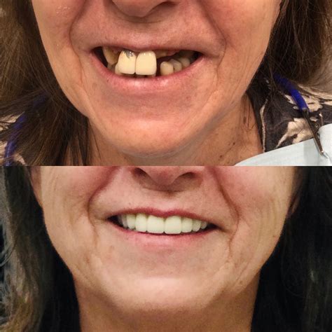 Memphis Dentures and Implants
