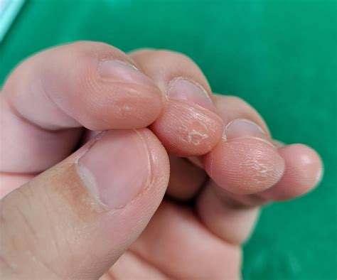 Callous Care Question : r/guitarlessons