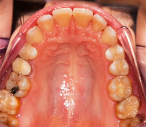 What Does Inside Your Mouth Look Like - Infoupdate.org