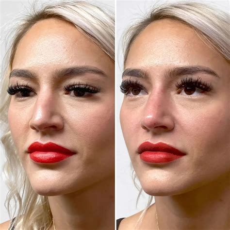 NoseFix: Filler