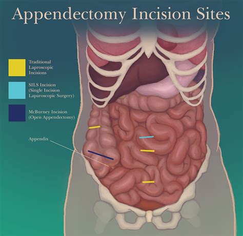 laparoscopic appendectomy incision sites