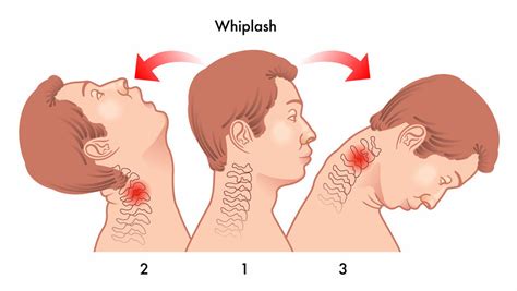 Whiplash Injury – Causes and Symptoms