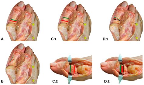 cpt akin osteotomy 1