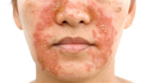 8 Common Types of Rashes | Christ Memorial