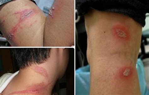 Queimadura De Inseto Na Pele - Conheça o Potó o inseto que causa queimaduras na pele! | Dermatolaser