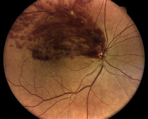 Retinal Vein Occlusion Orlando | Retina Consultants of Orlando