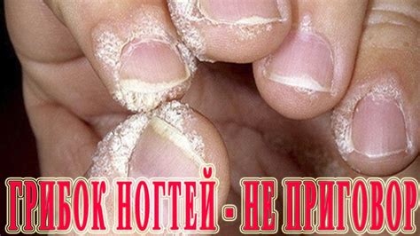 ★Онихомикоз - НЕ ПРИГОВОР! Лечение грибка ногтя Запущенная Форма ...