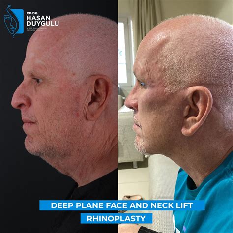 deep plane facelift  turkey istanbul dr hasan duygulu