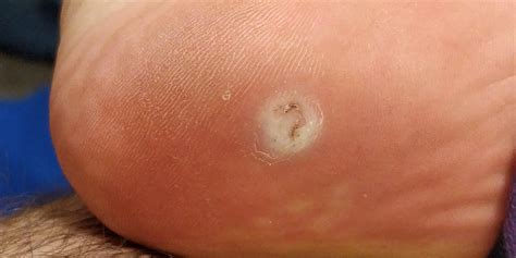 Nearly 2 months into this wart on my foot is it gone? : r/Warts