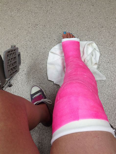 Broken Femur Cast
