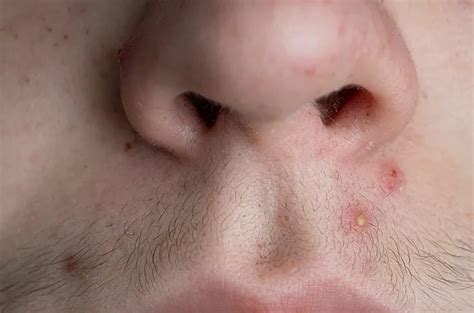 fakta tentang jerawat  atas bibir  bedanya  herpes