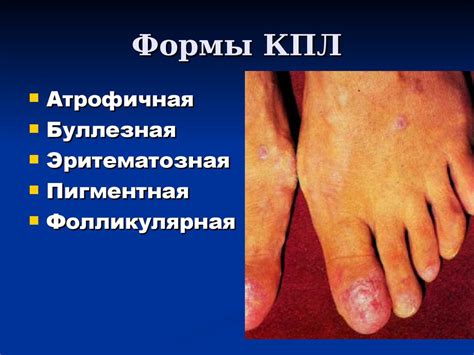 Псориаз - презентация онлайн
