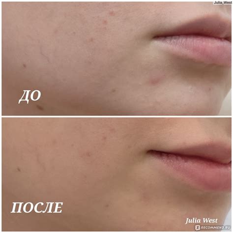 Патч (пластырь) против прыщей COSRX Acne Pimple Master Patch - «Моё ...