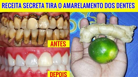 Como Amolecer O Dente Mais Rápido - Receita SECRETA vai Tirar o AMARELAMENTO dos Seus DENTES de Forma ...