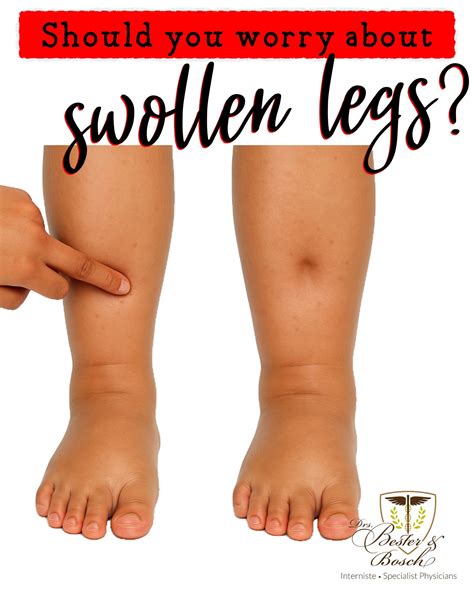 Drs - Swollen Legs: When to See a Doctor 🚨 Swollen legs are common