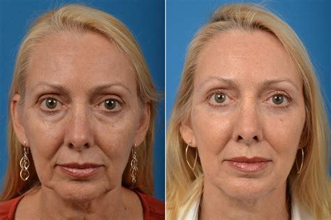 Eyelid Lift