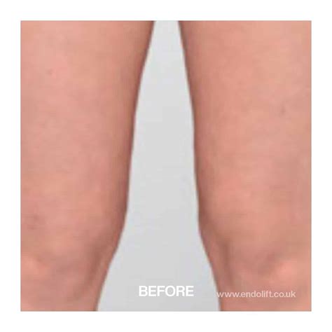 thigh lift liverpool skin tightening  thigh