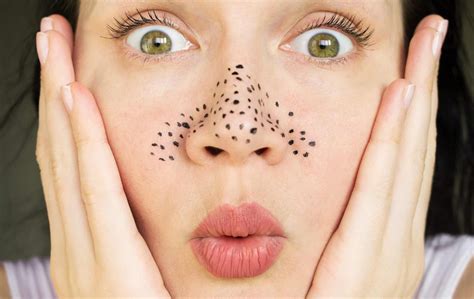 Puntos negros: ¿Cómo tratarlos y prevenir que regresen? [Con remedios ...