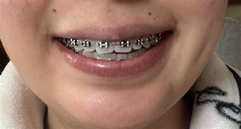 11 month update before pic last one : r/braces