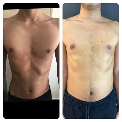 pectus excavatum sunken chest   risk factors vrogueco