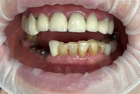 Корейські імпланти Osstem Implant: встановлення в Києві за вигідною ціною