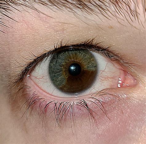 Why Is One Of My Eyes In Pain at Abbie Patterson blog