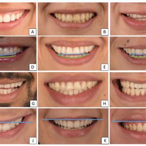 classification  smile  smile arc smile types  upper lip