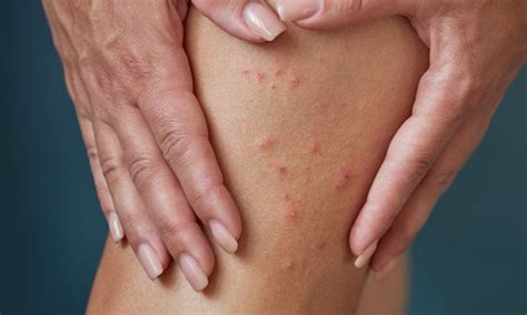 scabies  symptoms  effective treatments