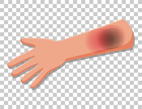 Bruised skin on an arm isolated on transparent background 1592235