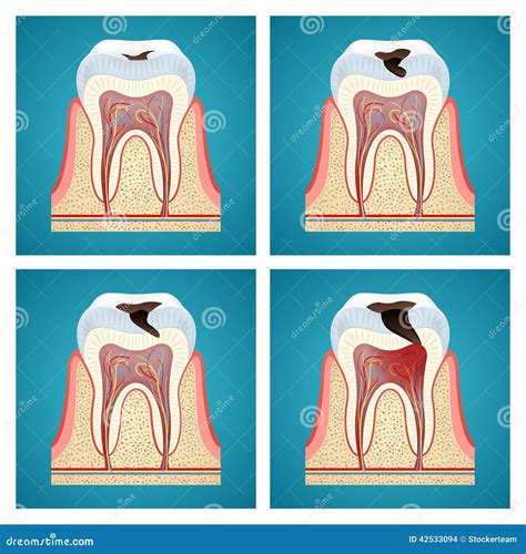 THE STAGES OF CARIES DEVELOPMENT Cartoon Vector | CartoonDealer.com