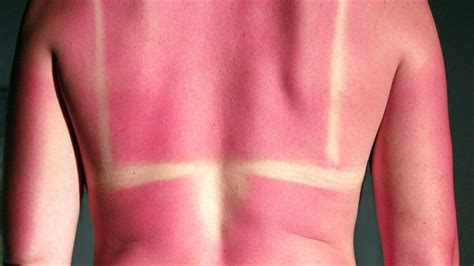 summer skin conditions   protect   sunburn sun