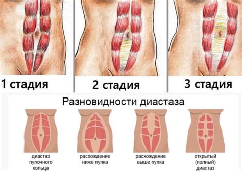 Диастаз прямых мышц живота: диагностика, симптомы, лечение - Пластика и ...