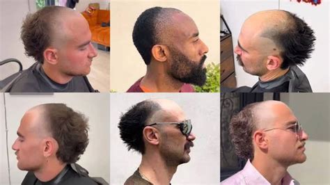 Calvo Com Cabelo Do Lado - Corte de cabelo ‘meio-calvo’ faz a cabeça dos homens brasileiros