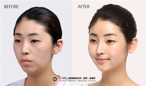 cinderella plastic surgery cinderella plastic surgery nose implants