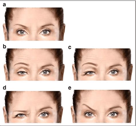 Ptosis explained: What it is and how to avoid it | Glowday