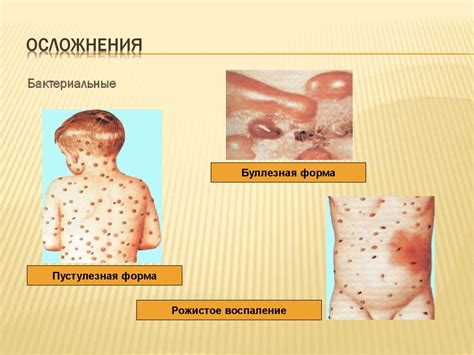 Ветряная оспа - online presentation