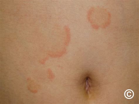 Annular erythema