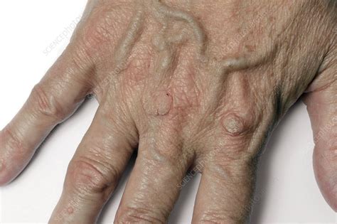 warts stock image  science photo library