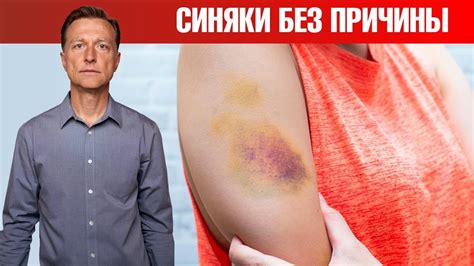 Почему появляются гематомы? Синяки на теле без причины🤷‍♀️ - YouTube