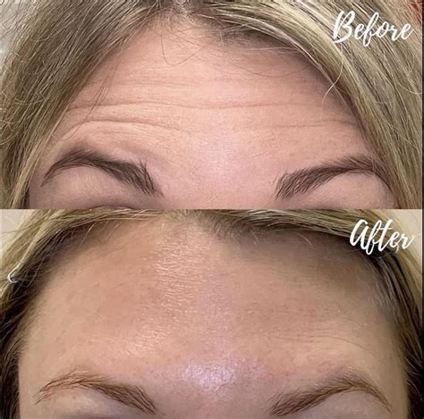 Before and After | Swisher Skin and Laser Center