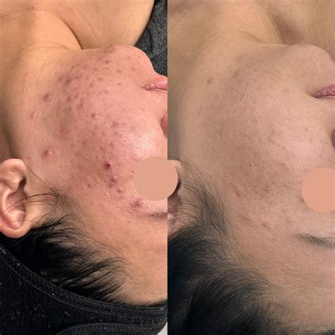 Acne & Inflamed Acne Treatments in Markham - Lashes & Lipstick Acne