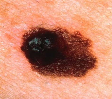 Nodular Melanoma